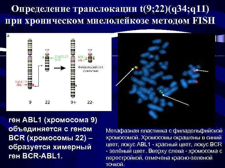 Определение транслокации t(9; 22)(q 34; q 11) при хроническом миелолейкозе методом FISH ген ABL