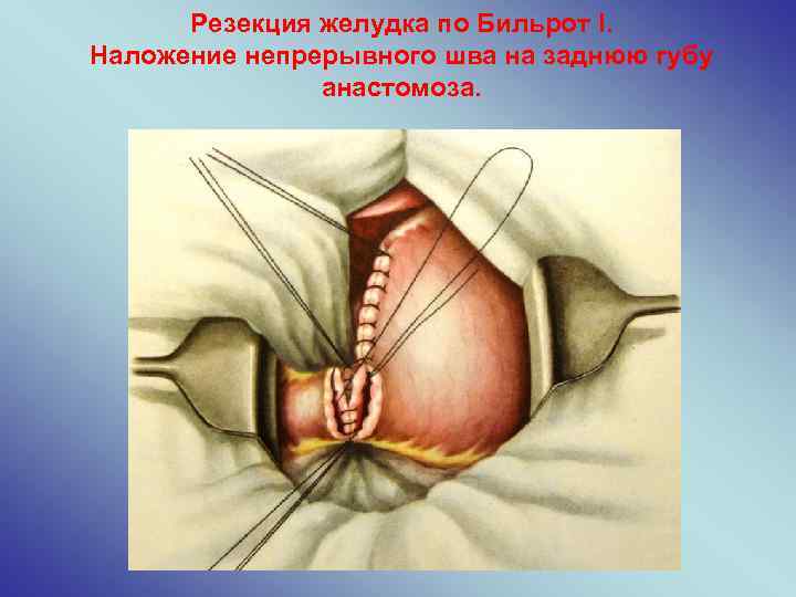 Резекция желудка по Бильрот I. Наложение непрерывного шва на заднюю губу анастомоза. 