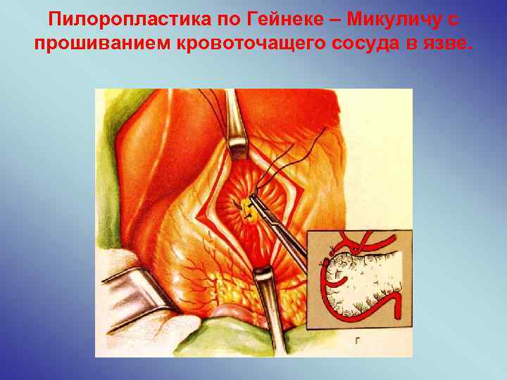 Пилоропластика по Гейнеке – Микуличу с прошиванием кровоточащего сосуда в язве. 
