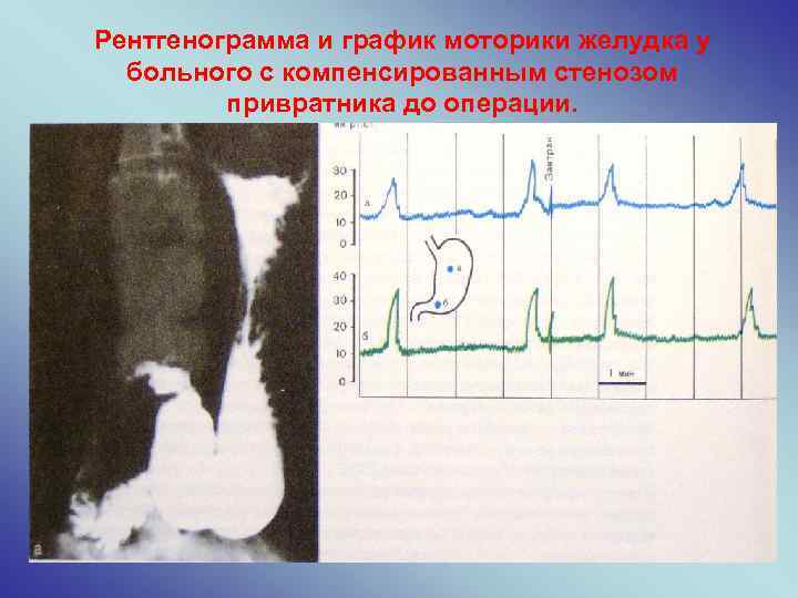 Рентгенограмма и график моторики желудка у больного с компенсированным стенозом привратника до операции. 
