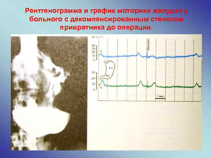 Рентгенограмма и график моторики желудка у больного с декомпенсированным стенозом привратника до операции. 