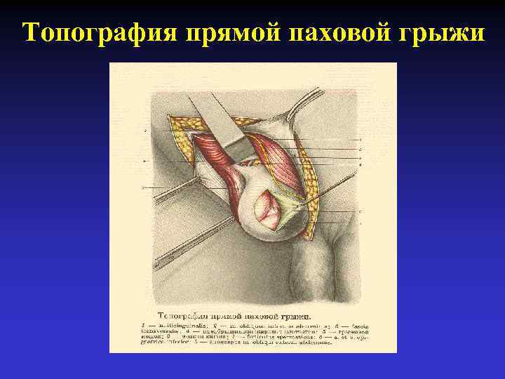 Топография прямой паховой грыжи 