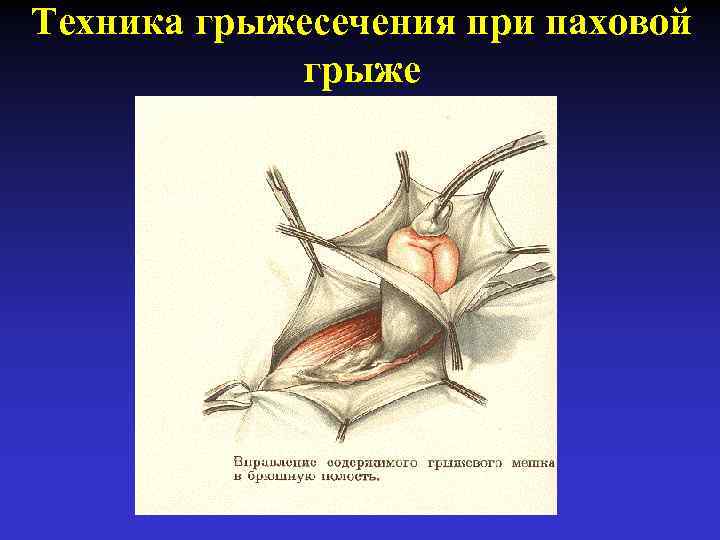 Техника грыжесечения при паховой грыже 