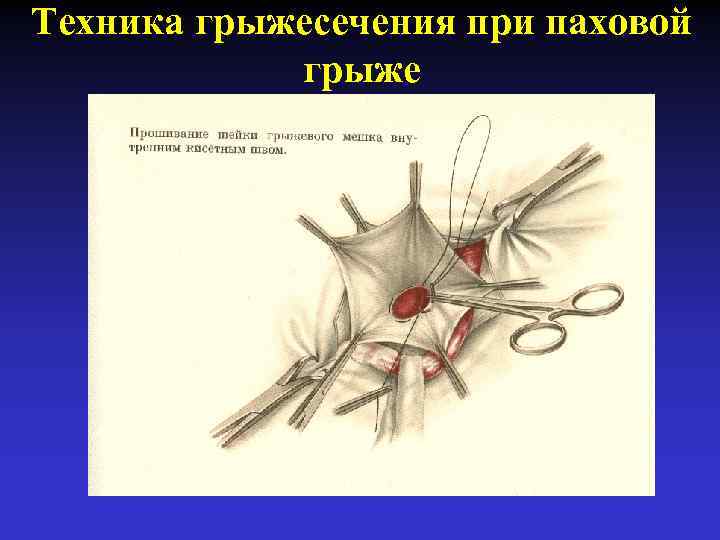 Техника грыжесечения при паховой грыже 