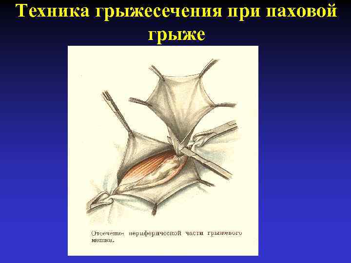 Грыжа передней брюшной стенки код