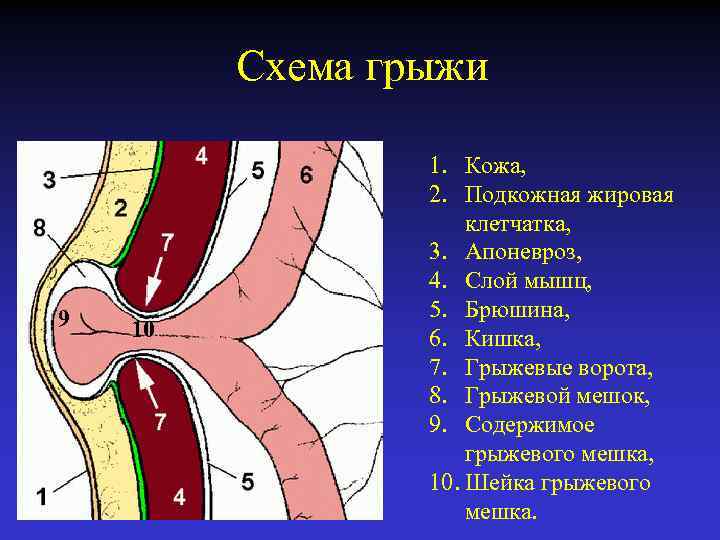 Схема грыжи 9 10 1. Кожа, 2. Подкожная жировая клетчатка, 3. Апоневроз, 4. Слой