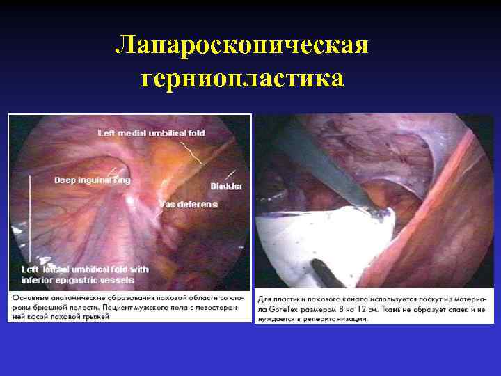 Лапароскопическая герниопластика 