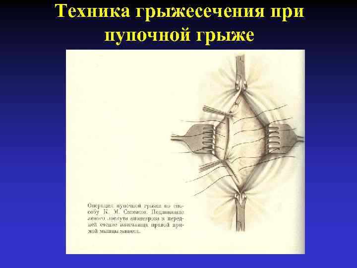 Им передней стенки мкб