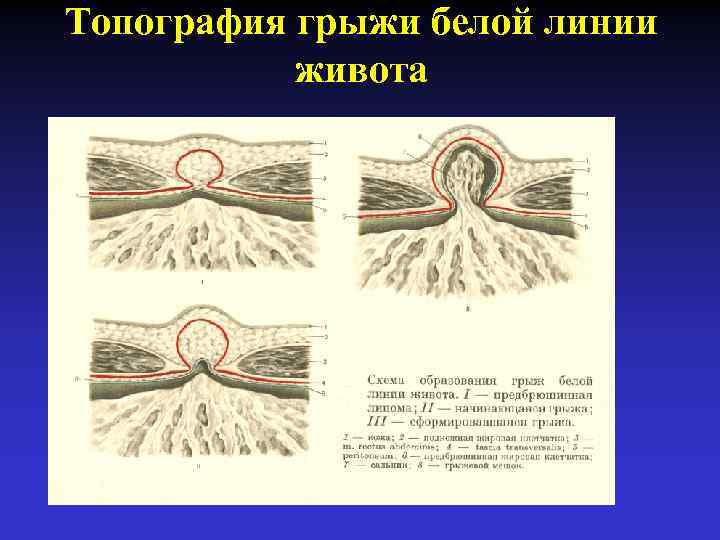 Топография грыжи белой линии живота 