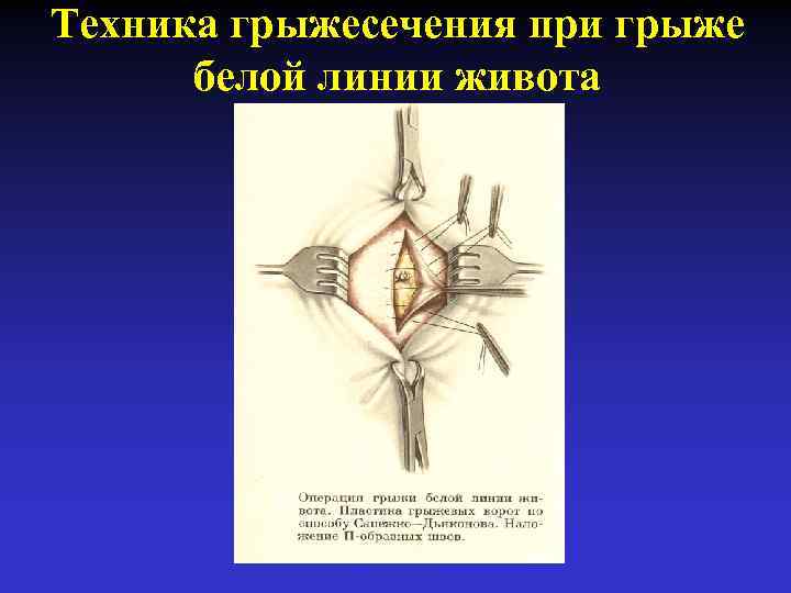 Грыжи передней брюшной стенки презентация