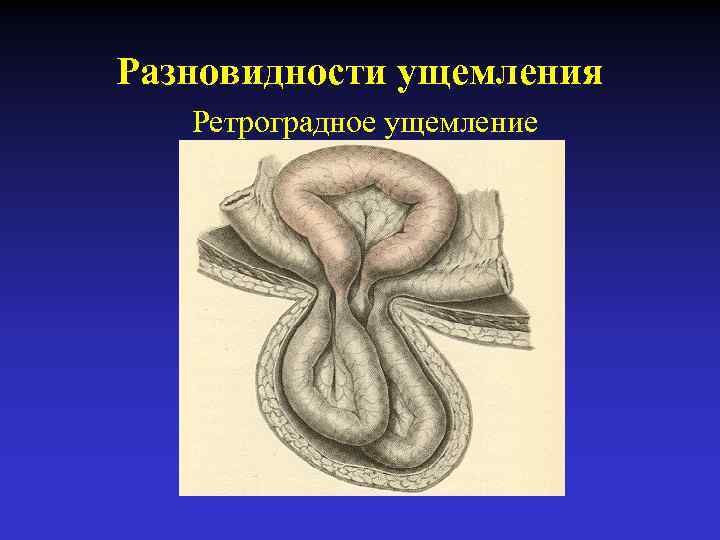 Грыжа брюшной стенки. Ретроградное ущемление грыжи. Рихтеровское и ретроградное ущемление в грыжах.. Ретроградное w образное ущемление. Ретроградное ущемление паховой грыжи.