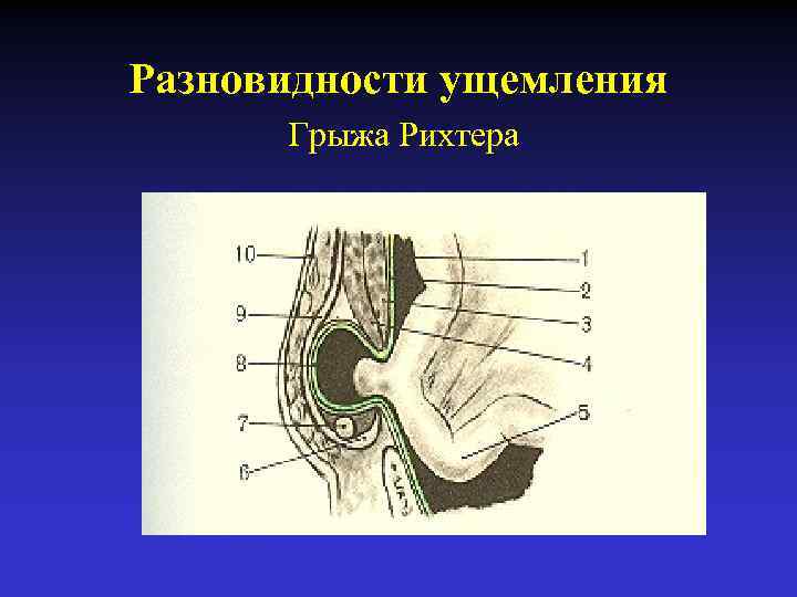 Ущемление паховой грыжи карта вызова