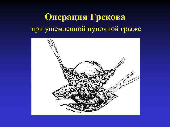 Операция Грекова при ущемленной пупочной грыже 