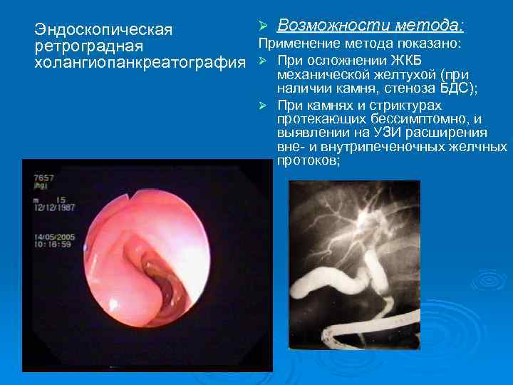 Ø Возможности метода: Эндоскопическая Применение метода показано: ретроградная холангиопанкреатография Ø При осложнении ЖКБ механической