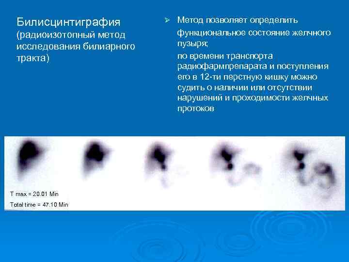 Билисцинтиграфия (радиоизотопный метод исследования билиарного тракта) T max = 20. 01 Min Total time