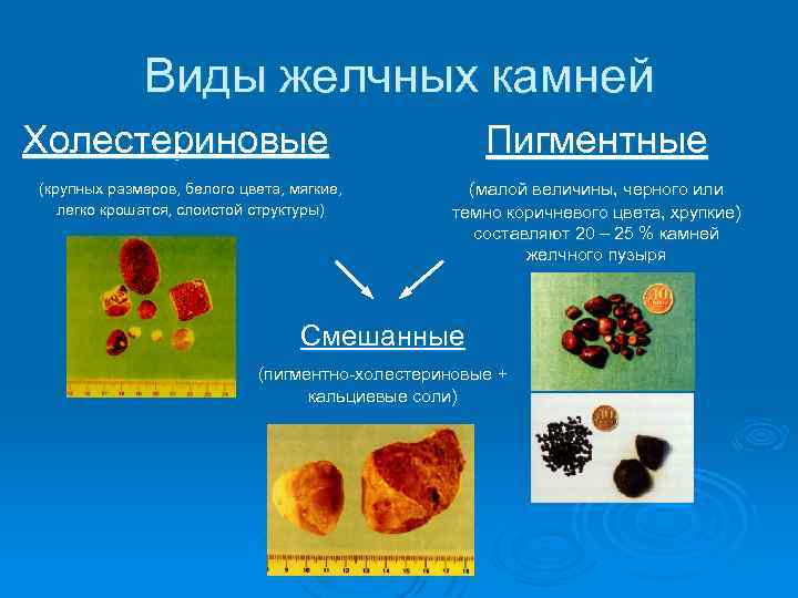 Виды желчных камней Холестериновые (крупных размеров, белого цвета, мягкие, легко крошатся, слоистой структуры) Пигментные