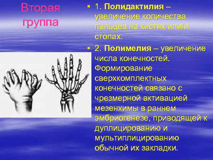 Вторая группа § 1. Полидактилия – увеличение количества пальцев на кистях или/и стопах. §