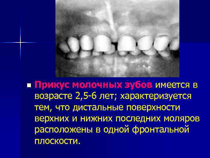 n Прикус молочных зубов имеется в возрасте 2, 5 -6 лет; характеризуется тем, что