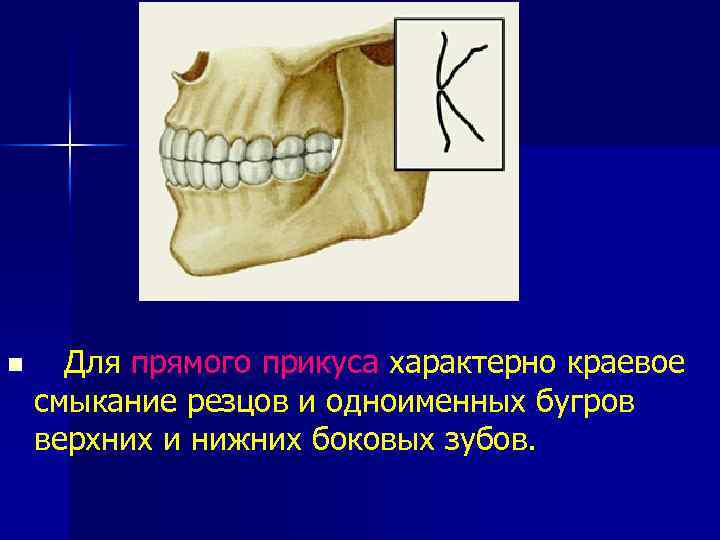 n Для прямого прикуса характерно краевое смыкание резцов и одноименных бугров верхних и нижних