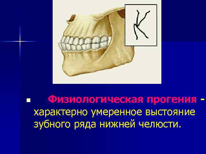 n Физиологическая прогения - характерно умеренное выстояние зубного ряда нижней челюсти. 