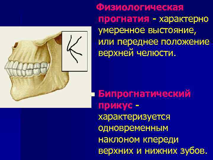  Физиологическая прогнатия - характерно умеренное выстояние, или переднее положение верхней челюсти. n Бипрогнатический