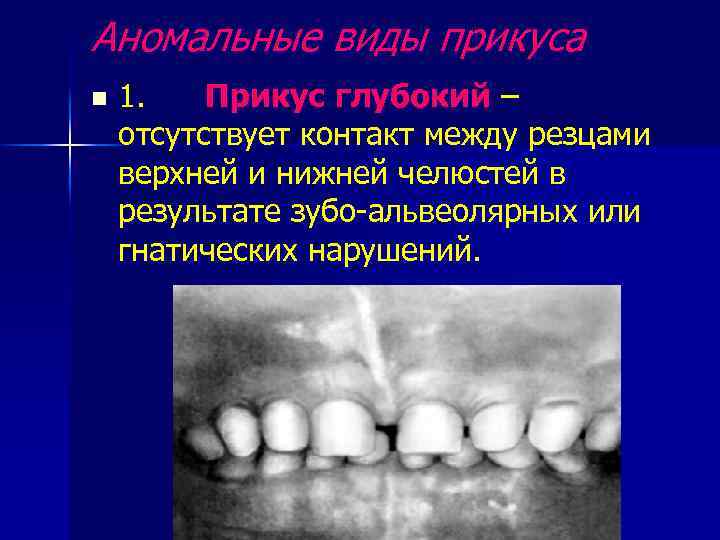 Аномальные виды прикуса n 1. Прикус глубокий – отсутствует контакт между резцами верхней и