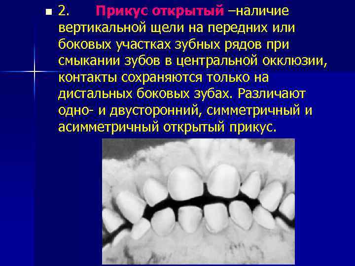 n 2. Прикус открытый –наличие вертикальной щели на передних или боковых участках зубных рядов