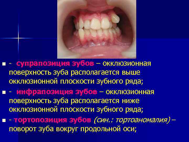 n n n - супрапозиция зубов – окклюзионная поверхность зуба располагается выше окклюзионной плоскости