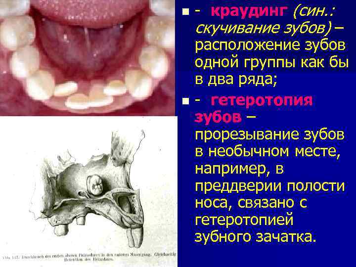 - краудинг (син. : скучивание зубов) – расположение зубов одной группы как бы в