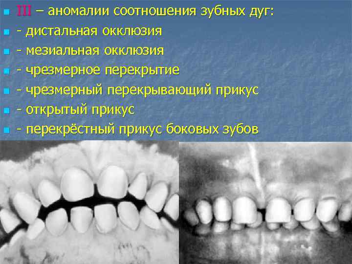 n n n n III – аномалии соотношения зубных дуг: - дистальная окклюзия -