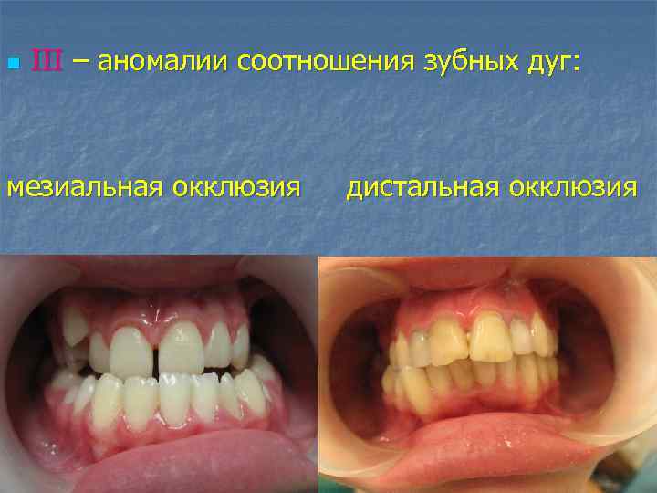 n III – аномалии соотношения зубных дуг: мезиальная окклюзия дистальная окклюзия 