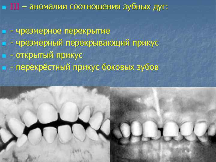 n n n III – аномалии соотношения зубных дуг: - чрезмерное перекрытие - чрезмерный