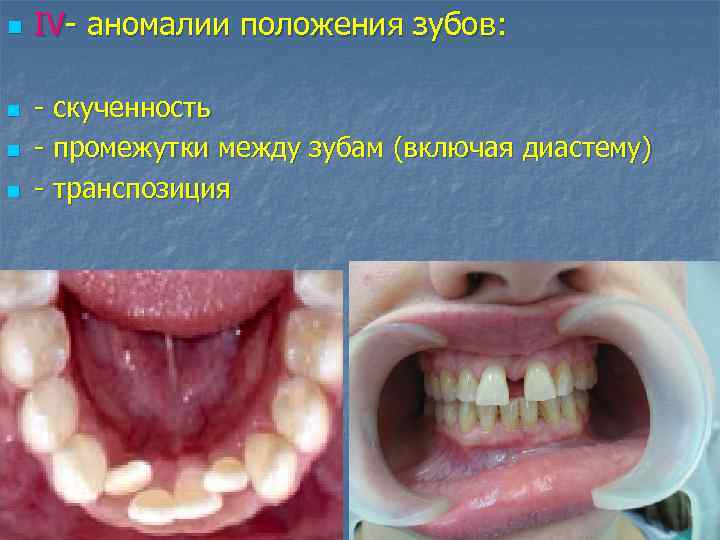 n n IV- аномалии положения зубов: - скученность - промежутки между зубам (включая диастему)