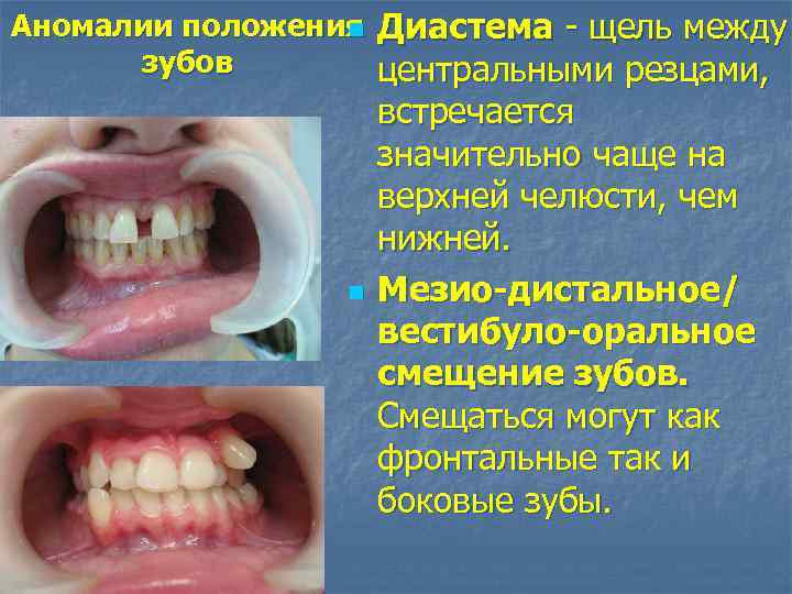 Аномалии положения Диастема - щель между n зубов центральными резцами, n встречается значительно чаще