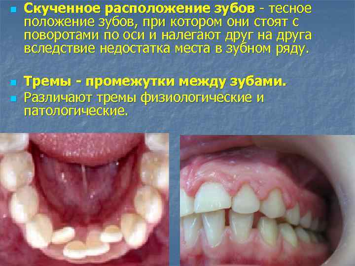 n n n Скученное расположение зубов - тесное положение зубов, при котором они стоят