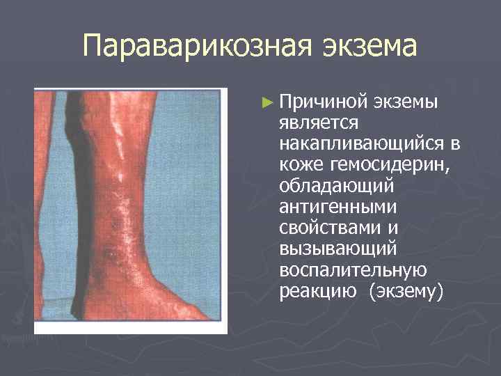 Параварикозная экзема ► Причиной экземы является накапливающийся в коже гемосидерин, обладающий антигенными свойствами и