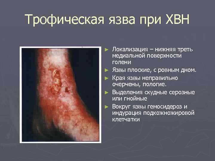 Трофическая язва при ХВН ► ► ► Локализация – нижняя треть медиальной поверхности голени