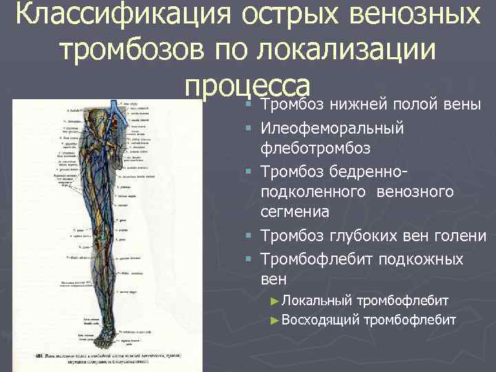 Тромбоз глубокой вены нижней конечности