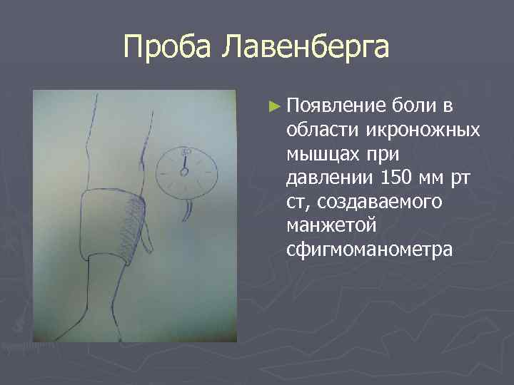 Проба Лавенберга ► Появление боли в области икроножных мышцах при давлении 150 мм рт