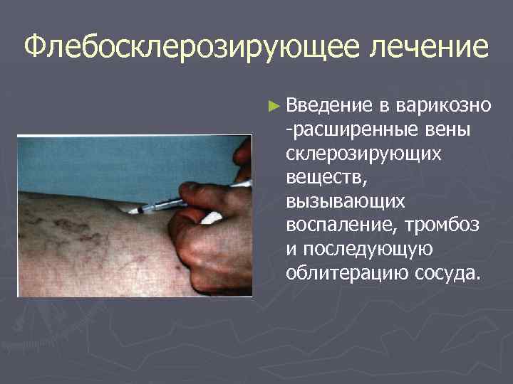 Флебосклерозирующее лечение ► Введение в варикозно -расширенные вены склерозирующих веществ, вызывающих воспаление, тромбоз и