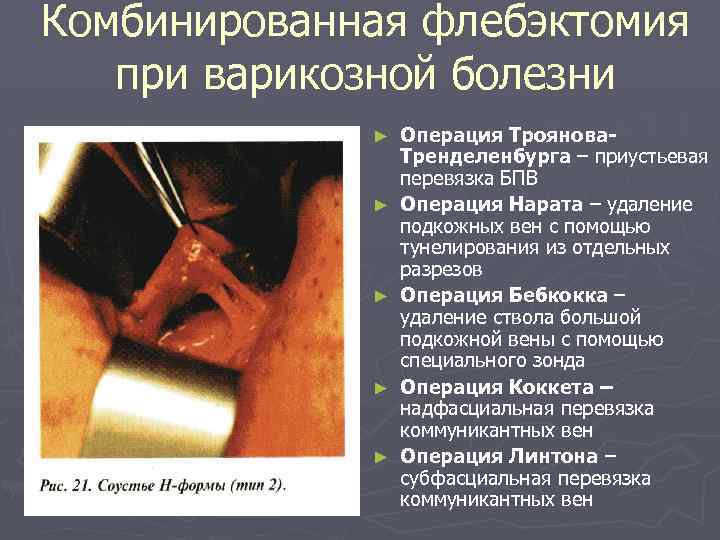 Комбинированная флебэктомия при варикозной болезни ► ► ► Операция Троянова. Тренделенбурга – приустьевая перевязка