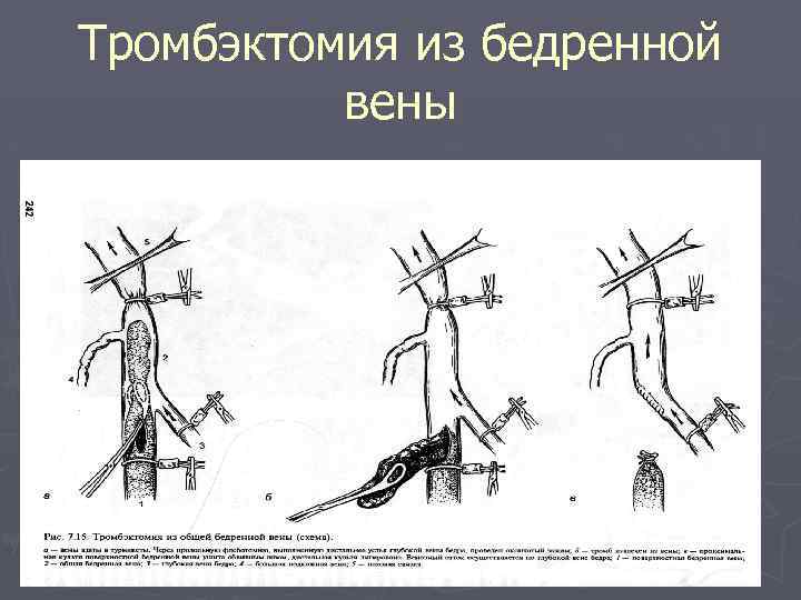 Карта вызова тромбоз вен