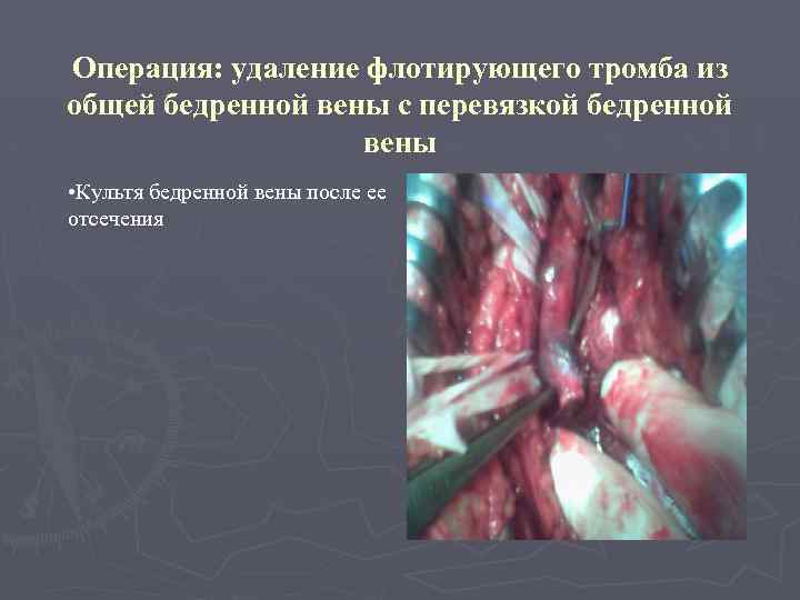 Операция: удаление флотирующего тромба из общей бедренной вены с перевязкой бедренной вены • Культя