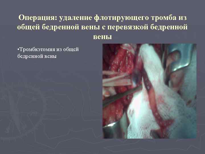 Операция: удаление флотирующего тромба из общей бедренной вены с перевязкой бедренной вены • Тромбкэтомия