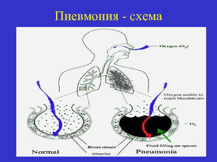 Пневмония 4. Пневмония схема. Пневмонии схема и рисунок. Пневмония картинки схемы. Динамика пневмония схема.