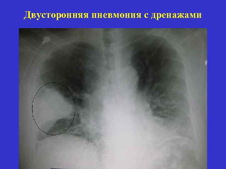 Двухсторонняя пневмония. Двусторонняя субтотальная пневмония пневмонии. Двусторонняя субтотальная сливная пневмония. Панлобулярная пневмония двусторонняя. Двусторонняя субтотальная вирусно бактериальная пневмония.