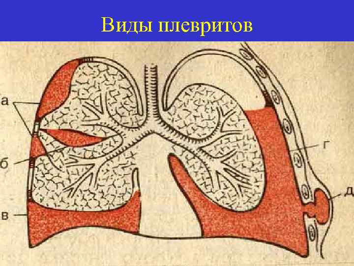 Виды плевритов 