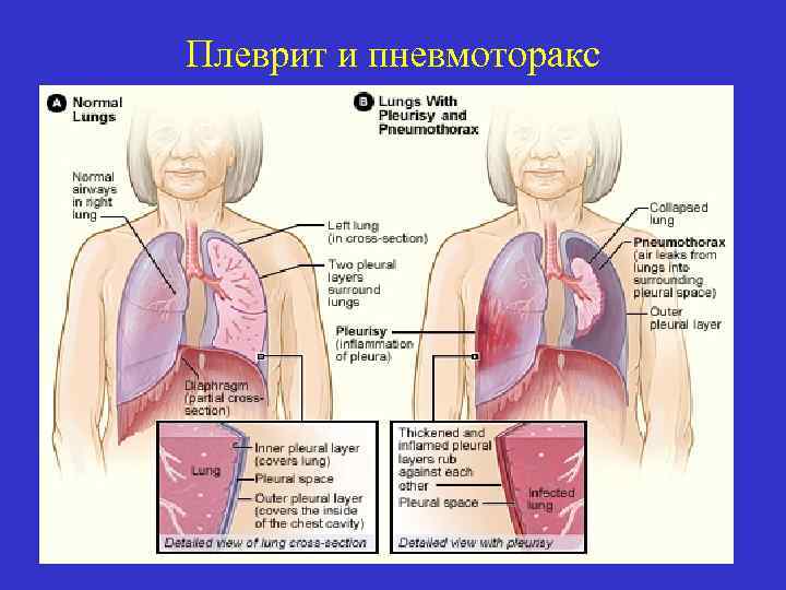 Плеврит и пневмоторакс 