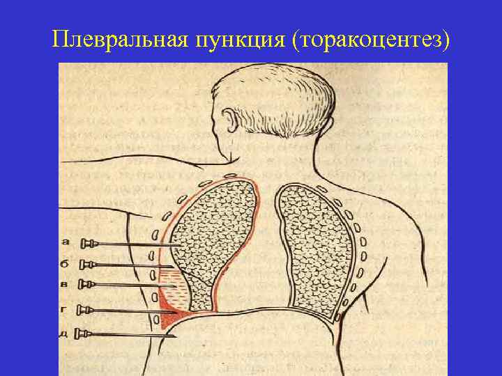 Плевральная пункция (торакоцентез) 