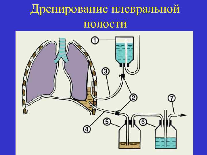 Дренирование плевральной полости 